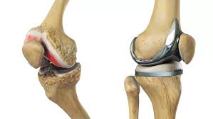 Best Knee Replacement In Nagpur