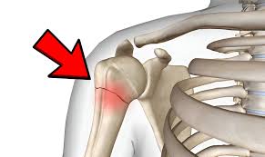 Best Shoulder Fracture In Nagpur
