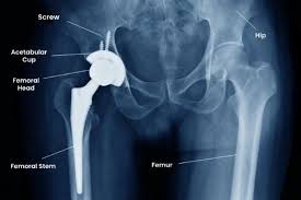Hip Replacement Surgeon In Nagpur