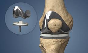 Joint Replacement In Nagpur