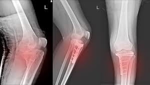 Knee Fracture Surgery In Nagpur