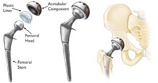 Minimally invasive hip surgery Nagpur