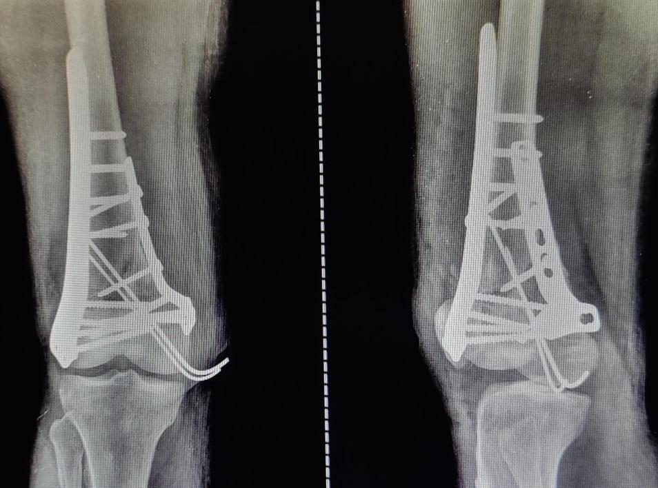 Complex Femur Fracture with Excellent Result after Orthopaedic Surgery in Nagpur