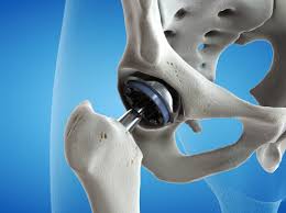 Quick recovery hip surgery Nagpur