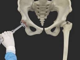 Robotic-assisted hip replacement Nagpur